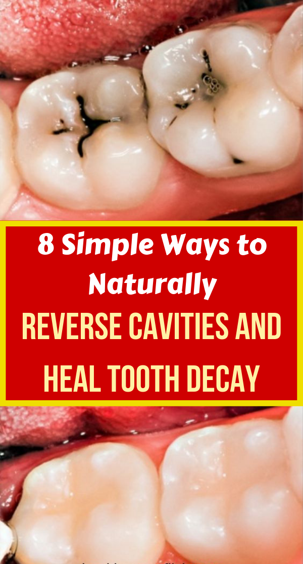 How To Reverse Natural Tooth Decay And Remineralize Teeth At Home Wellness Twelve How To Reverse Natural Tooth Decay And Remineralize Teeth At Home Wellness Twelve