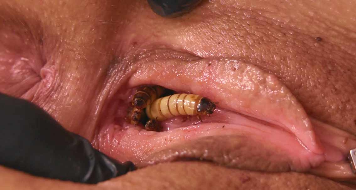 Worms In Pussy Speculum.