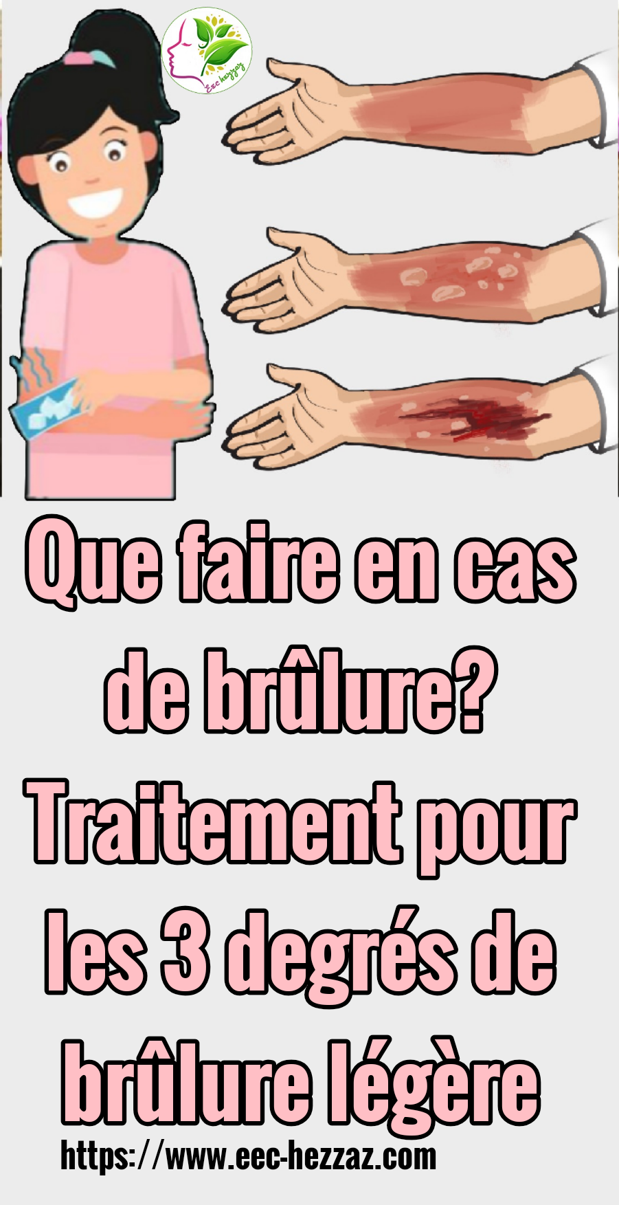 Que faire en cas de brûlure? Traitement pour les 3 degrés de brûlure légère