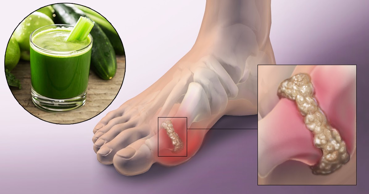 A Lemon Green Juice To Suppress The Crystallization Of Uric Acid From