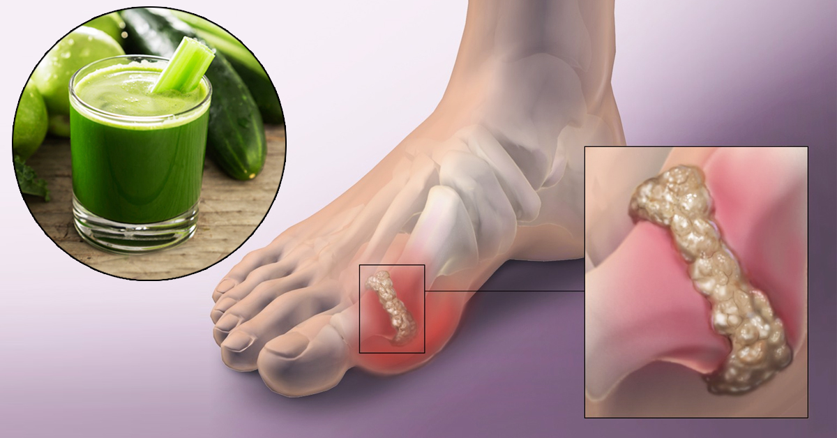 A Lemon Green Juice To Suppress The Crystallization Of Uric Acid From