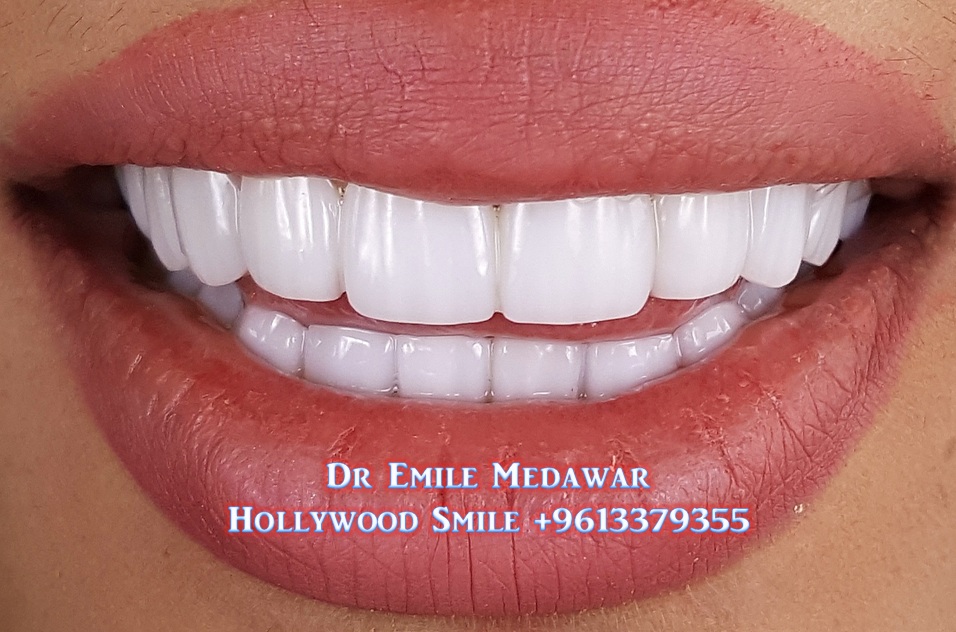 Dental Implants, Dental Veneers, Hollywood Smile, Gummy Smile, Clip on