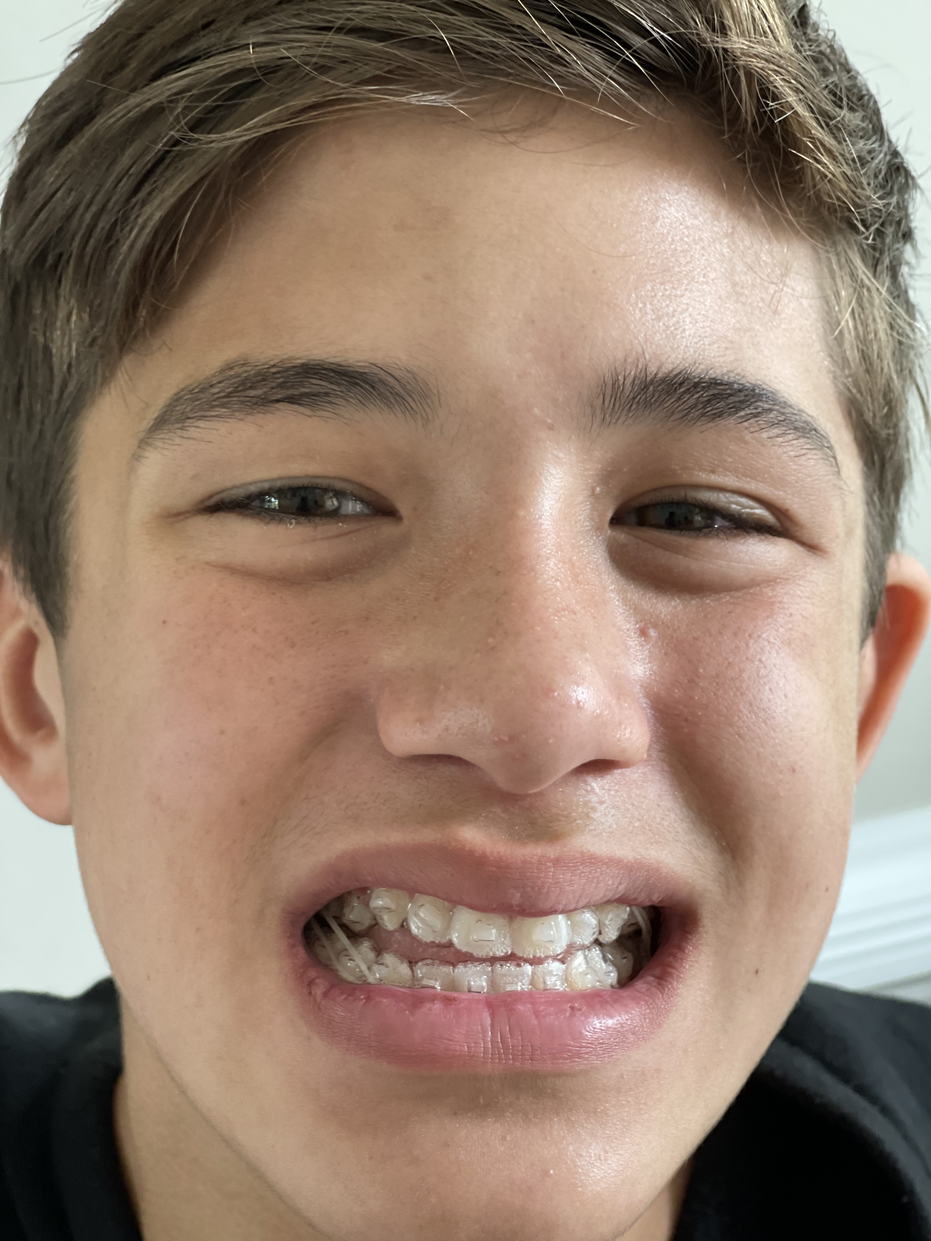 The Vernon Blog Braces for Connor! Invisalign Install