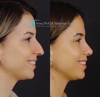 Burun Estetigi Sonrasi Sislik Ne Zaman Iner