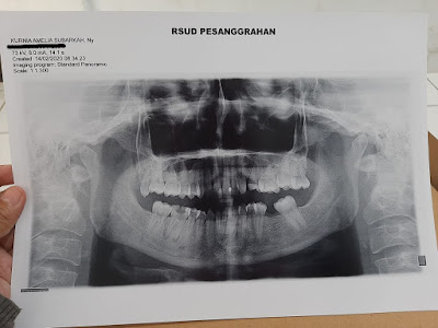 operasi kista gigi