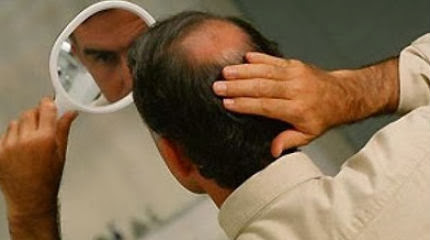 Αφήνεις... φαλάκρα;