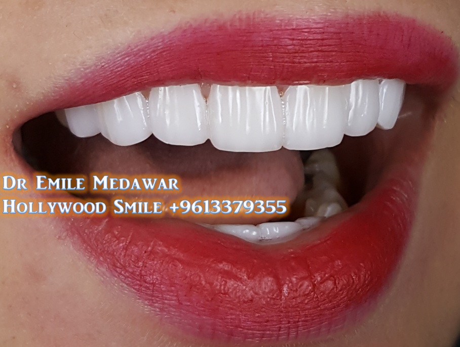 Hollywood Smile Veneers Celebrities by Dr Emile Medawar, Cosmetic Dentist and Dental Implants