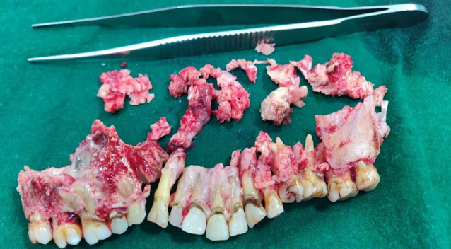 mucormycosis Infected Teeth and jaw removed after operation
