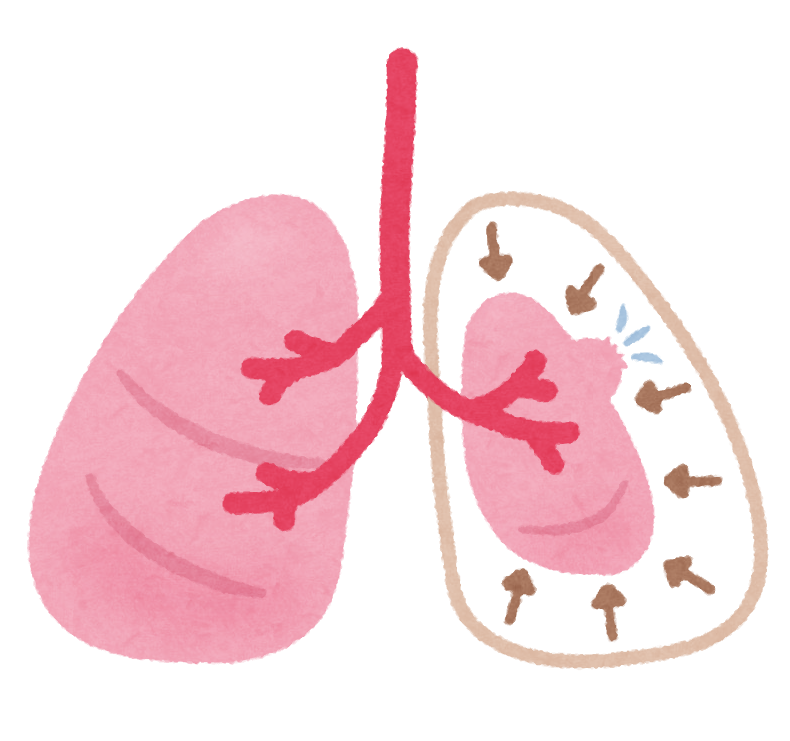 肺 気胸 イケメン