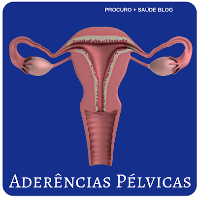 Aderências pélvicas