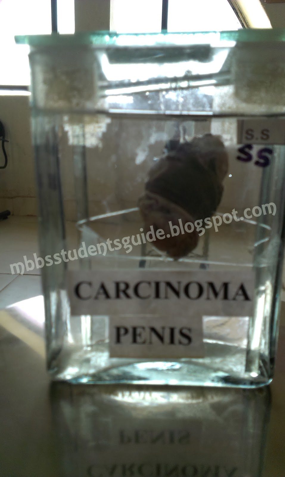 Pathology Practicles - Gross Apecimens (Photos) | M.B.B.S Students Guide