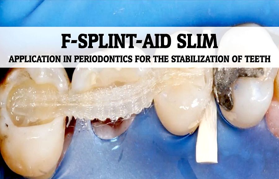 STABILIZATION OF TEETH FSPLINTAID SLIM Application in Periodontics