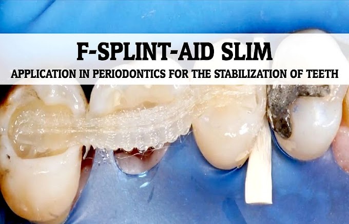 STABILIZATION OF TEETH: F-SPLINT-AID SLIM - Application in Periodontics - Dr. Hagner