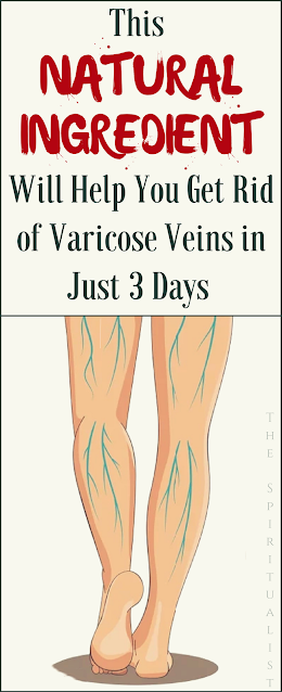 This Natural Ingredient Will Help You Get Rid Of Varicose Veins In Just 3 Days !
