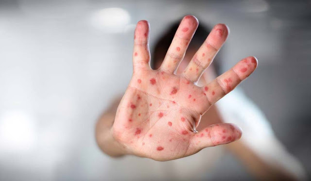 Baianos com viagem marcada para São Paulo devem ser vacinados contra o sarampo