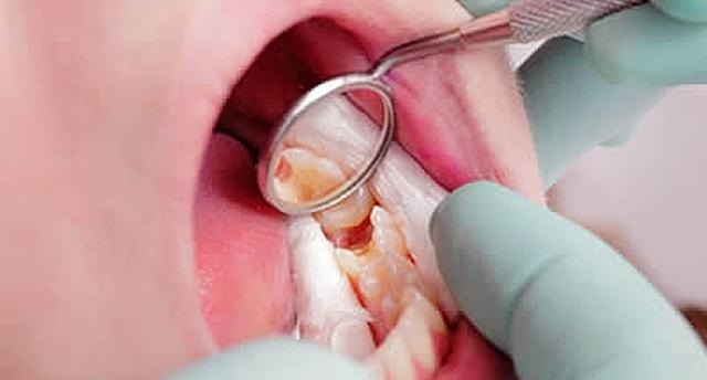 Ternyata Begini Cara Mudah Atasi Gigi Berlubang dengan