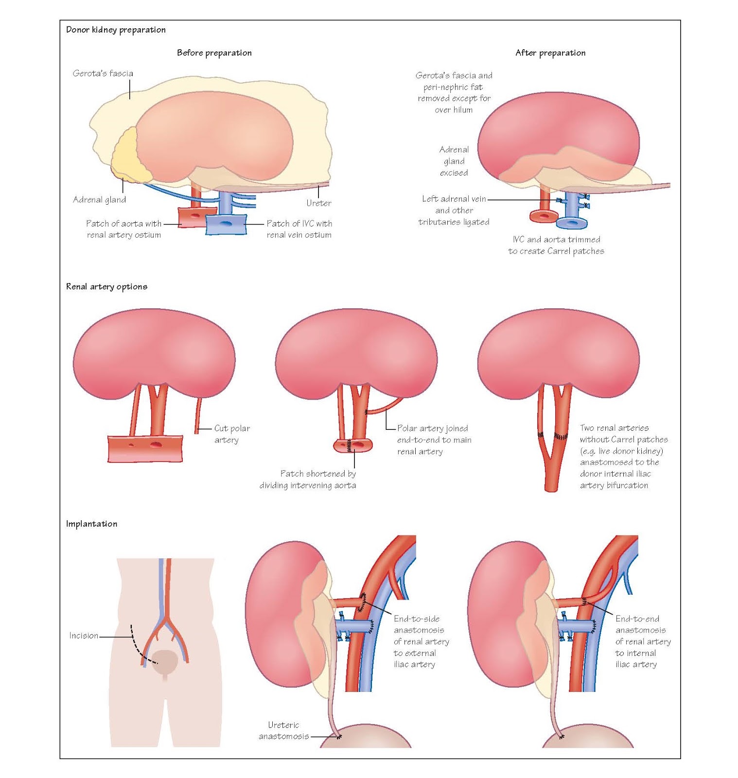 Kidney Transplantation The Operation pediagenosis
