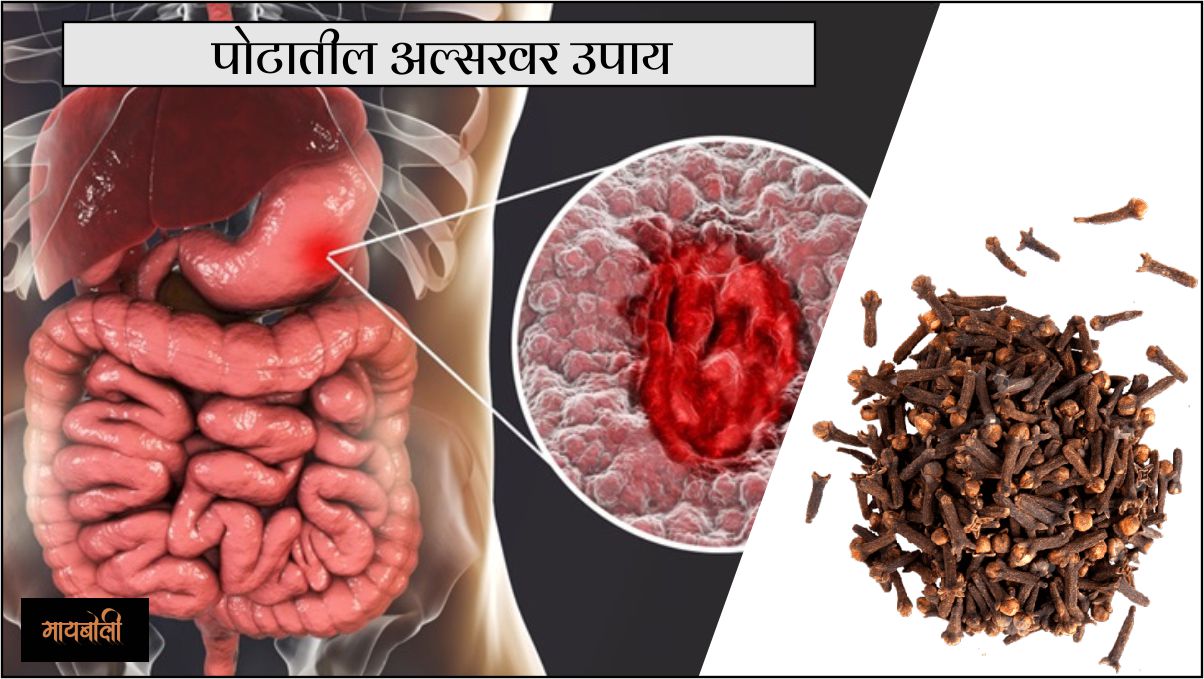 पोटातील अल्सरवर उपाय पोटातील अल्सरवर उपाय