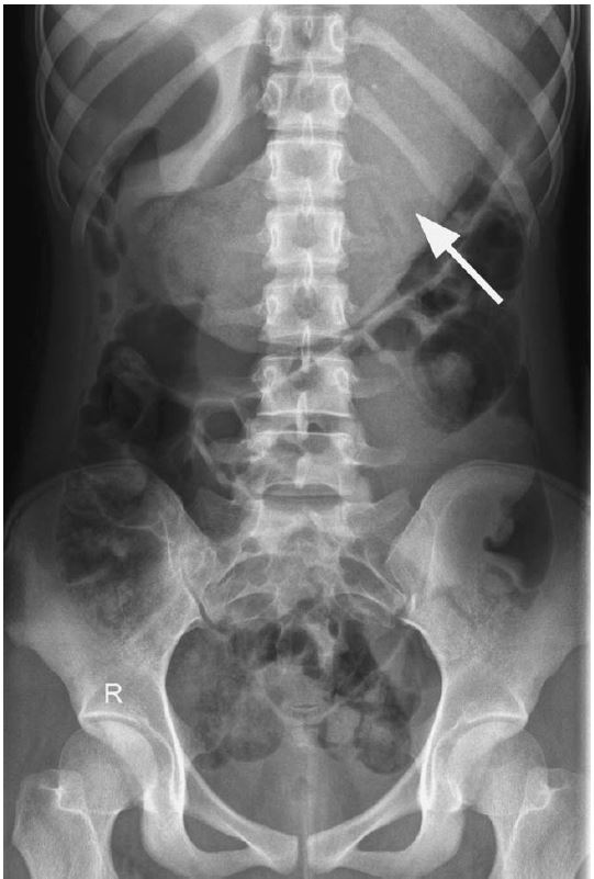 Bezoar Xray, Barium Studies, and CT Scan Examination RadTechOnDuty