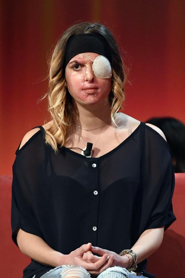 Beauty Queen ‘Whose Boyfriend Threw Acid In Her Face’ Reveals Her Shocking Scars For The First