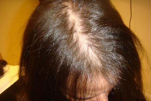 وصفة طبيعية لمنع سقوط الشعر بعد الرجيم والحميات