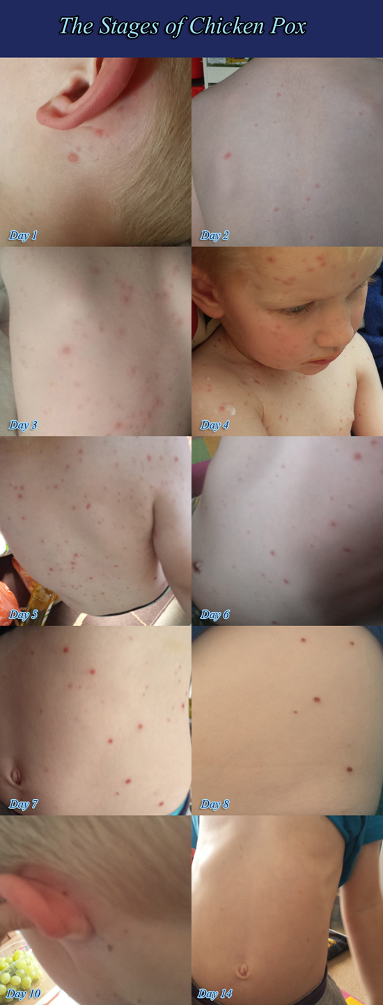 Photos of Chicken Pox at various stages
