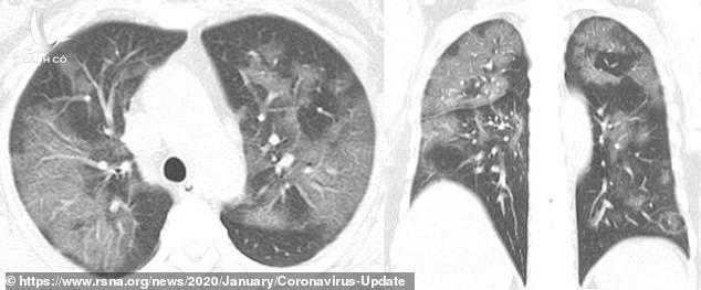 Hình ảnh trực quan mà SARS-CoV-2 gây ra với phổi của người bệnh