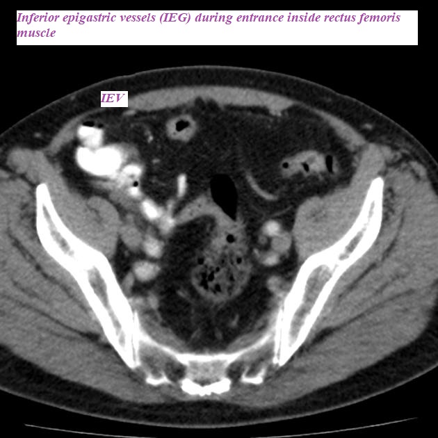 Undescended Testicle.