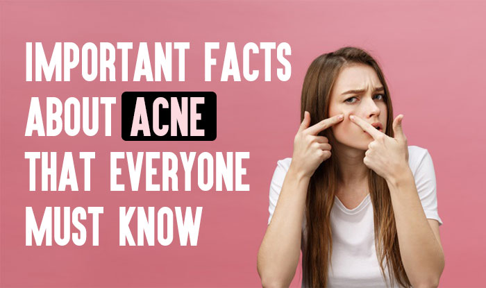 Important Facts About Acne That Everyone Must Know