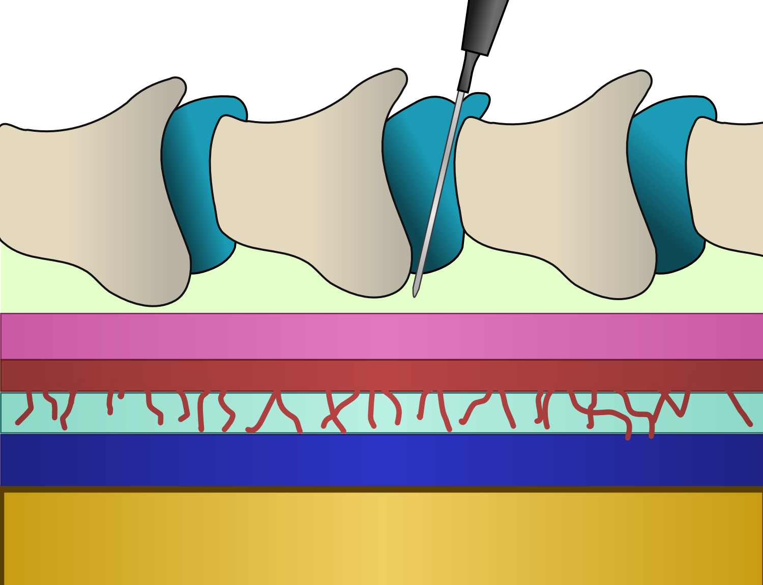 PreClic Anestesia raquídea y epidural pinta aquí, pinta allá. ¿Con qué?