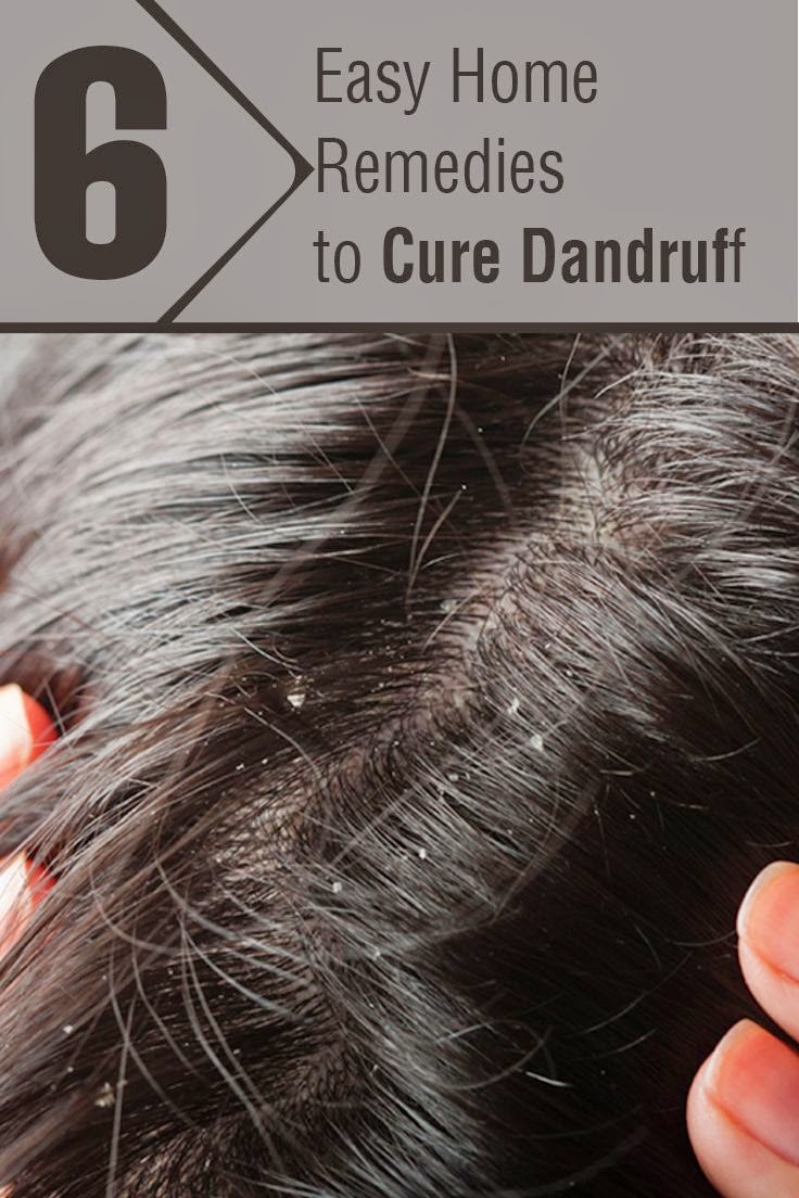 Six Easy Tips of Dandruff Treatments Medi Tricks