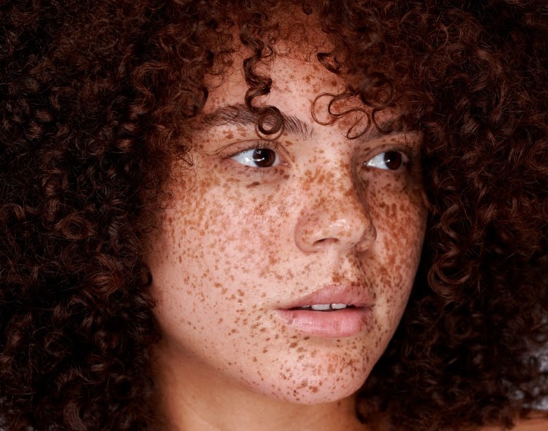 Are Your Freckles A Sign Of Sun Damage Miss Stonehouse