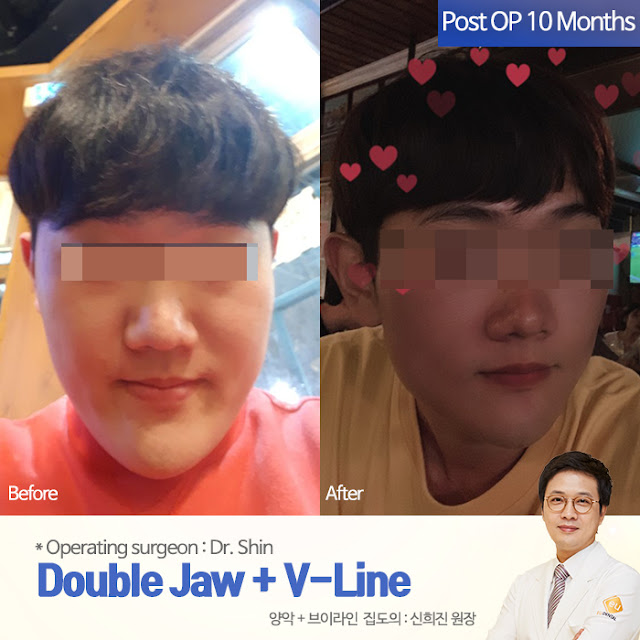 Lantern Jaw improve with jaw surgery in Korea _ EU