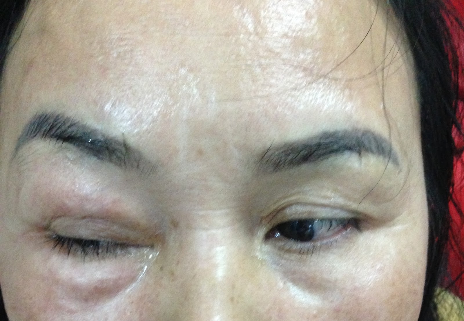 VIETNAMESE MEDIC ULTRASOUND CASE 423 BLACK EYEBROW SIGN, Dr PHAN