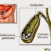 CPT Code for Cholelithiasis and Gallstones