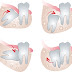 Nguyên nhân răng khôn mọc lệch gây đau