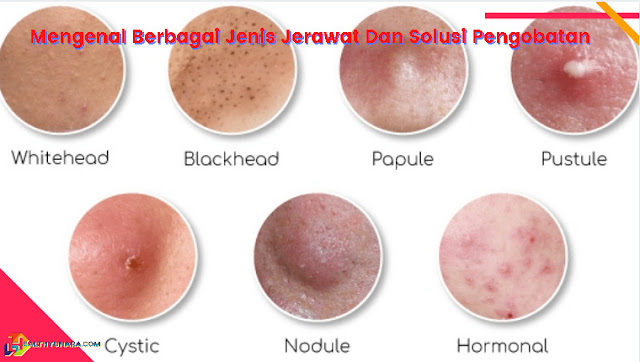 Mengenal Berbagai Jenis Jerawat Dan Solusi Pengobatan Mengenal Berbagai Jenis Jerawat Dan Solusi Pengobatan