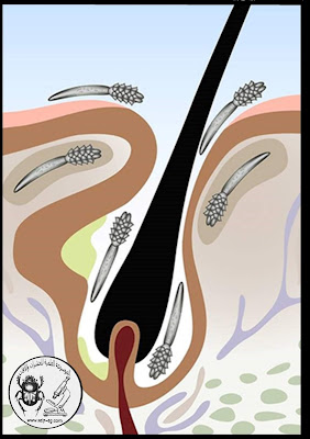 طفيل ديمودكس Demodex folliculorum (عث الوجه)