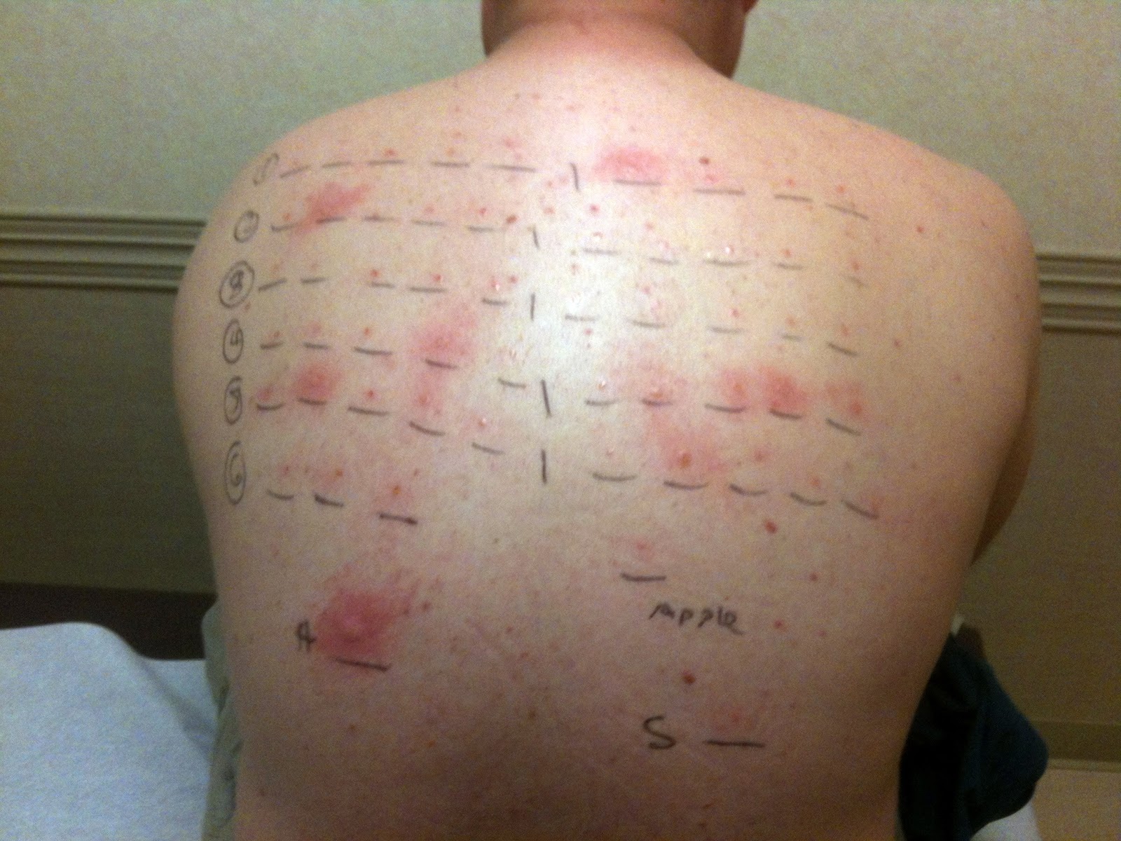 Hamburke Allergy Testing