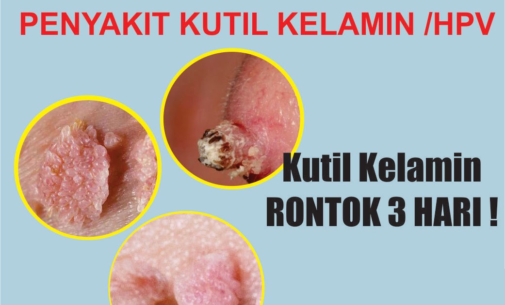 ubat sifilis berkesan