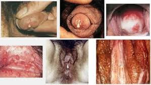 Keputihan Berlebihan Pada Vagina Keputihan Berlebihan Pada Vagina