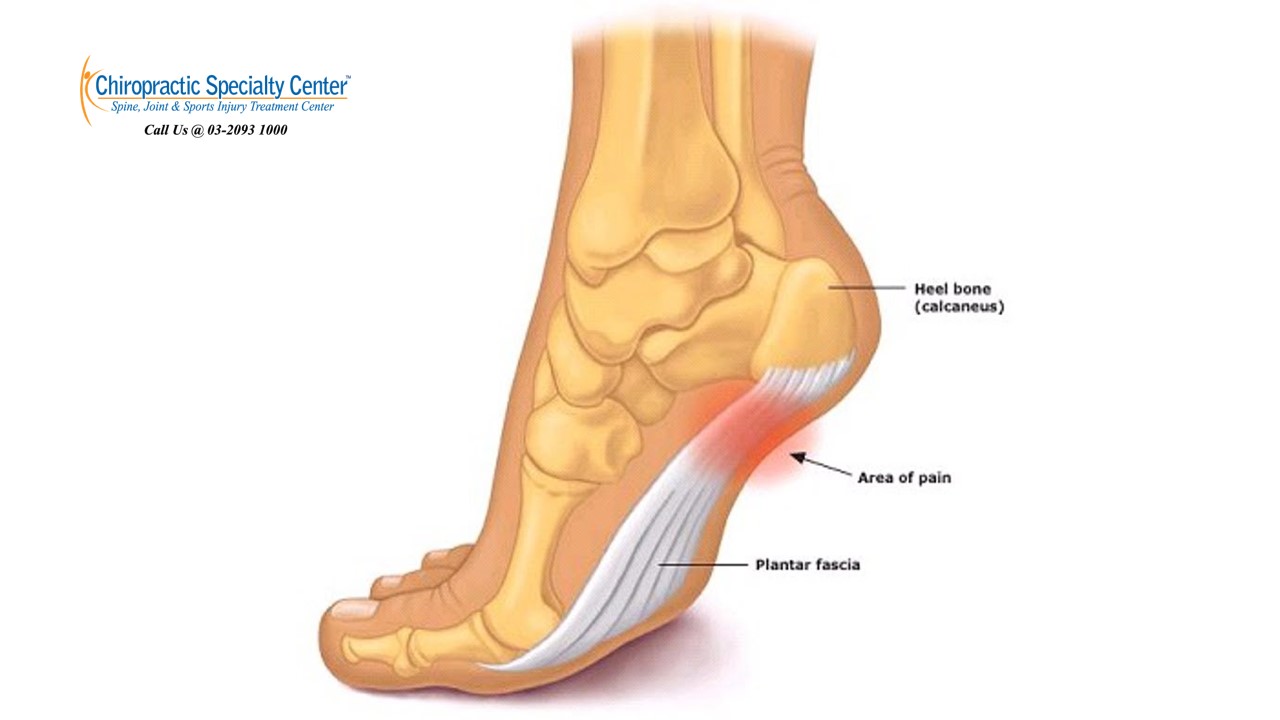 Plantar Fasciitis Treatment Pain In Heel Area Of Foot Fasciitis
