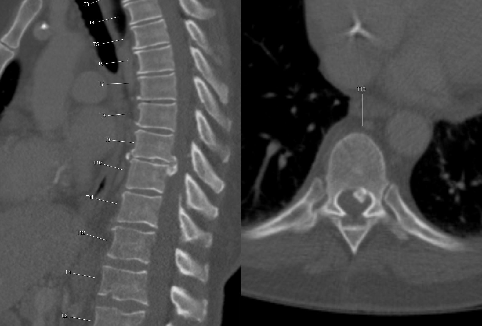 Calcified Thoracic Disc Herniation