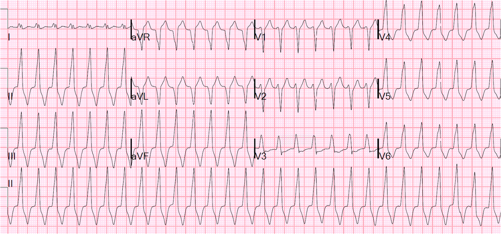 dr-smith-s-ecg-blog-regular-wide-complex-tachycardia-what-is-the