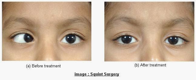 Squinting meaning. Эзотропия. Эволюция глаза. Operation methods of strabismus. Squint перевод.
