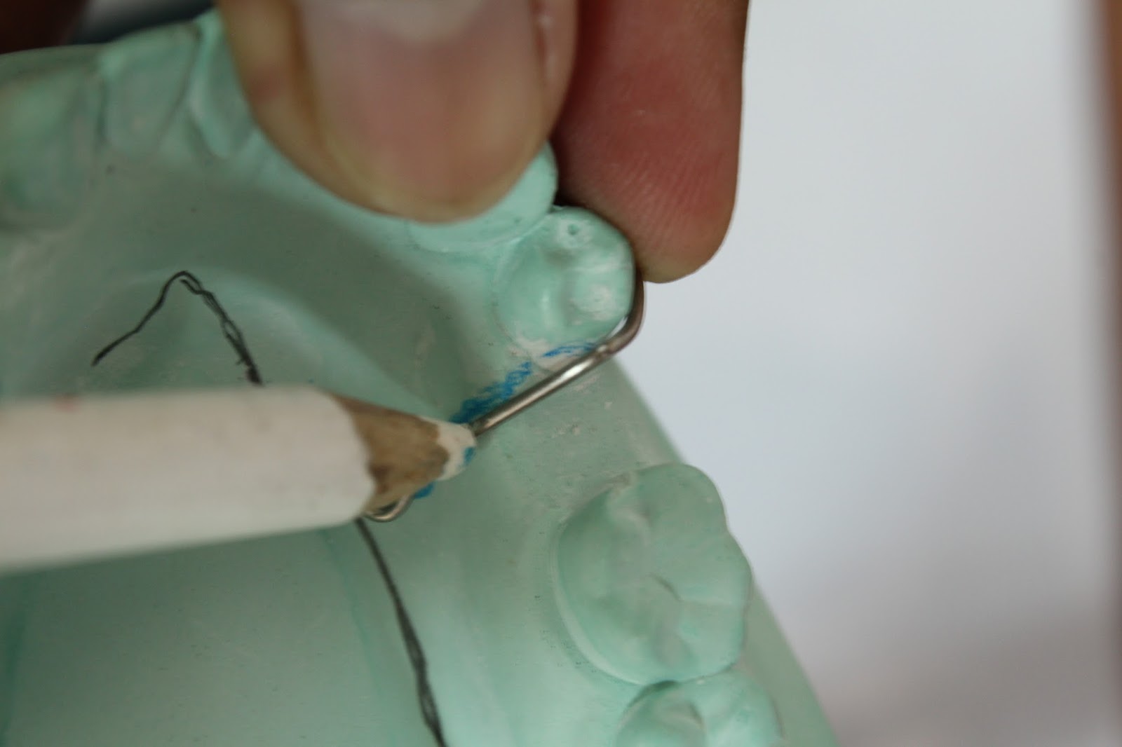 Understanding Prosthodontics Tagore Dental College & HospitalBy