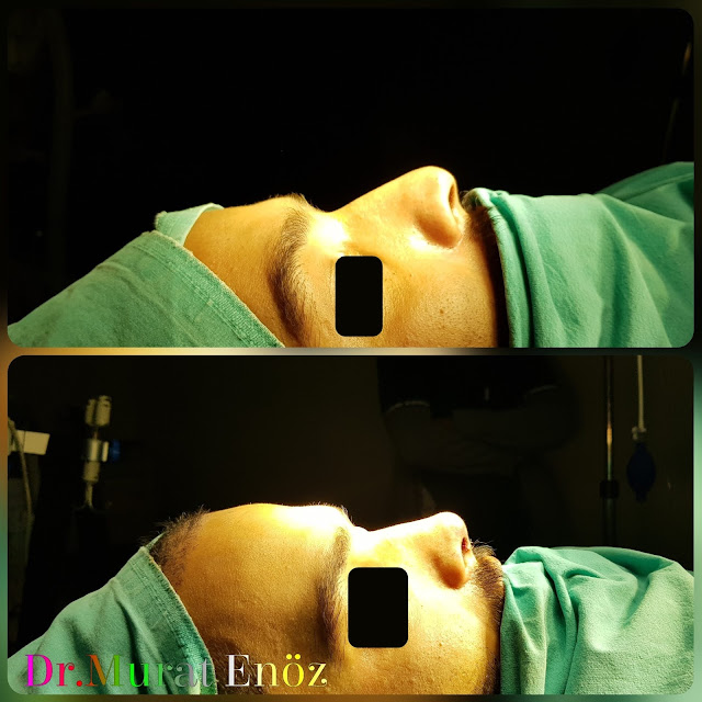 Nose Tip Plasty, Nose Tip Lifting,droopy nose tip,