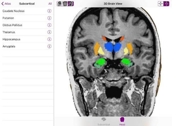 Imagen de resonancia magnética extraída de Brain Tutor (con permiso)