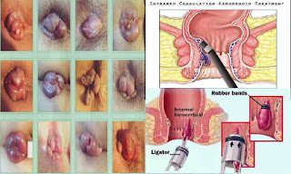 cara mengobati ambeien saran dokter tanpa operasi