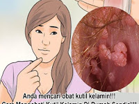 Obat Herbal Kutil Kelamin Atau Kutil Di Kemaluan Dalam